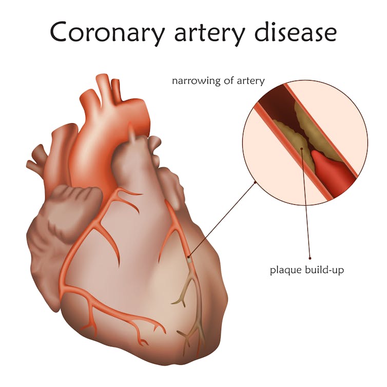 A diagram that shows the human heart and an artery blocked by cholesterol.